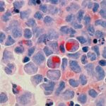 Más de 18 millones de personas en el mundo morirán de cáncer en 2050, un 75% más que ahora