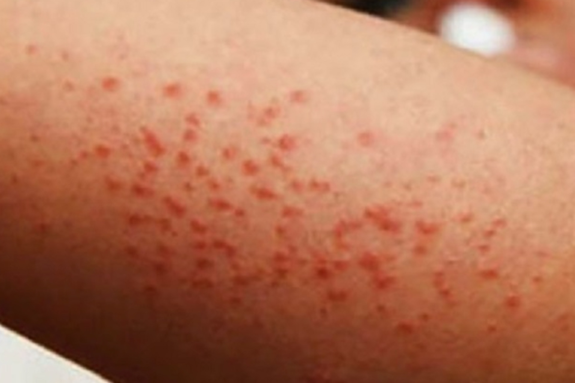 Hemos contenido brotes de sarampión, particularmente Chihuahua: David Kershenobich