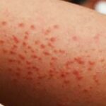 Hemos contenido brotes de sarampión, particularmente Chihuahua: David Kershenobich Hemos contenido brotes de sarampión, particularmente Chihuahua: David Kershenobich