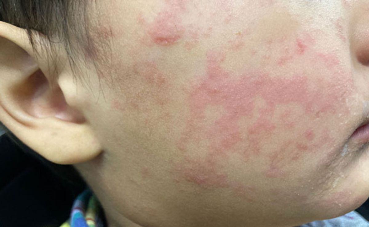 Advierten que plan antivacunas de Florida abre la puerta al sarampión en EE.UU.