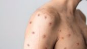 Foto ilustrativa de la nota titulada: La OMS registra más de 26 mil casos de mpox en la primera mitad del año, la mayoría en África