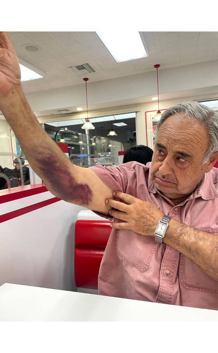 rafie-ollah-shouhed-muestra-las-lesiones-que-le-causaron-en-su-detencion-por-agentes-migratorios Trump acumula demandas millonarias por detención de ciudadanos en redadas - rafie-ollah-shouhed-muestra-las-lesiones-que-le-causaron-en-su-detencion-por-agentes-migratorios